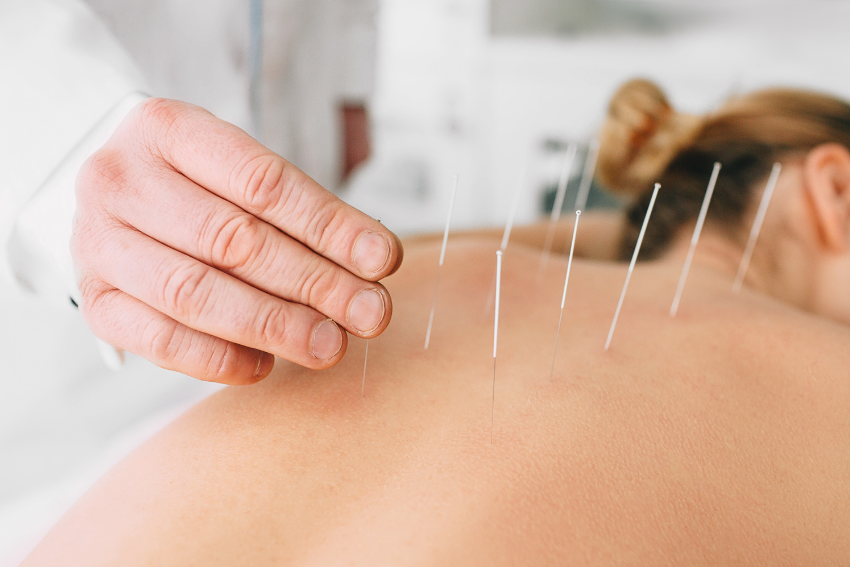 Acupuncture Services in Hamilton